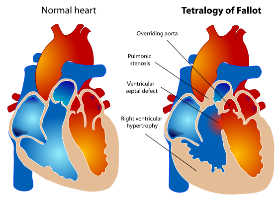 Difference Between Cyanotic And Acyanotic Congenital Heart Defects Compare The Difference Between Similar Terms