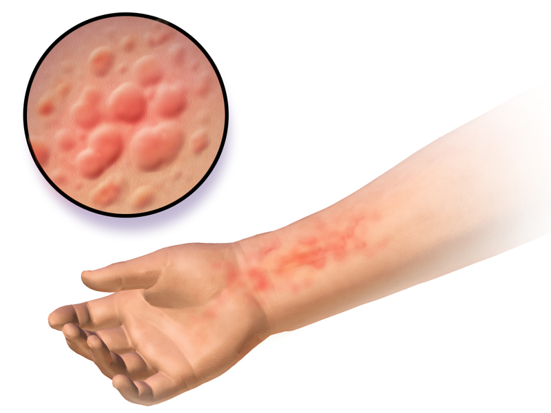 Difference Between Hives And Scabies Compare The Difference