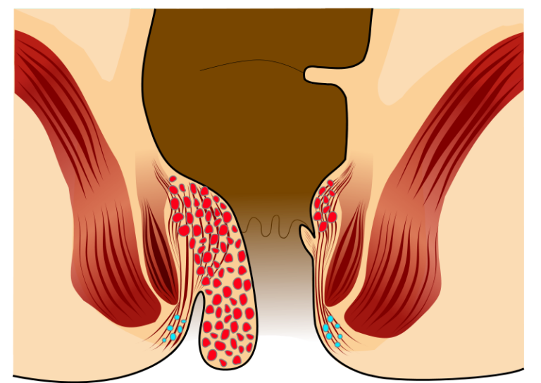 Ulcerative Colitis vs Piles in Tabular Form